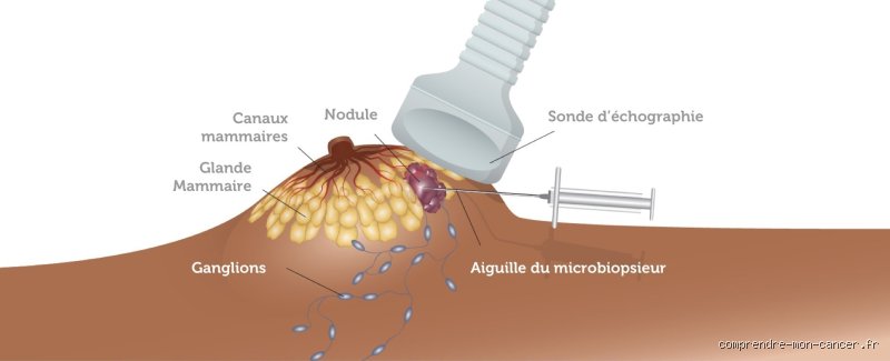 Est-ce que la biopsie du sein fait mal ? Réponse complète et honnête