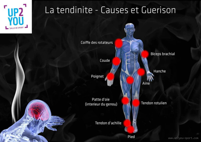 Est-ce que le stress peut provoquer une tendinite ? Découvrez la vérité