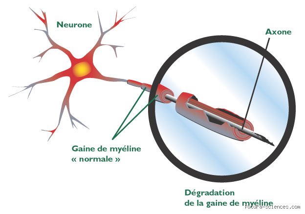 Quelle maladie détruit la myéline ?