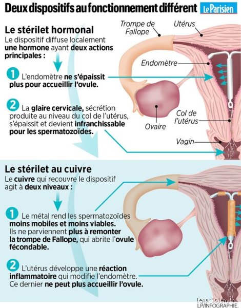Est-ce que l'homme sent le stérilet lors d'un rapport ?