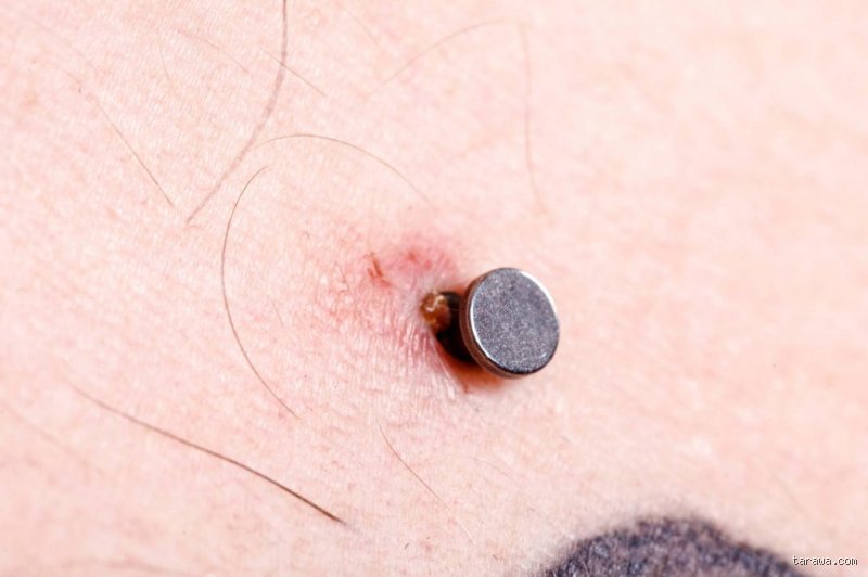 Pourquoi j'ai une boule à mon piercing ?