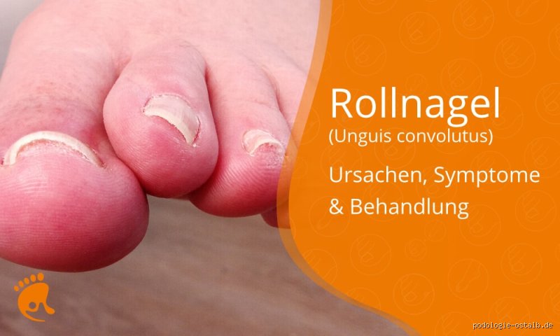 Wie sieht ein Rollnagel aus?